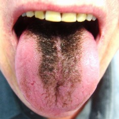 Black Hairy Tongue  SQ 1159  1 