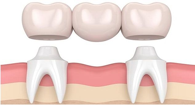 Γέφυρες δοντιών: διαδικασία, κόστος και τύποι οδοντικών γεφυρών
