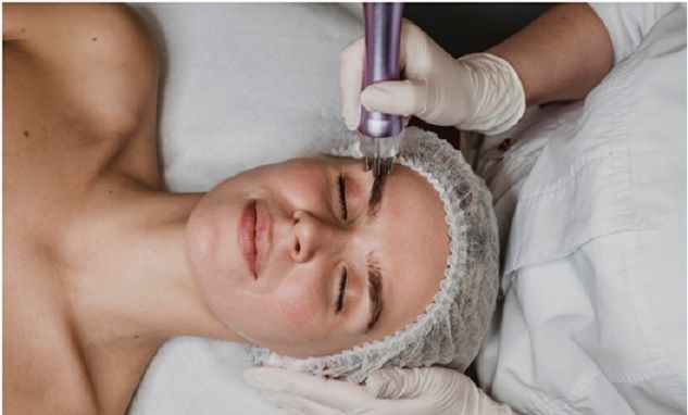 Fractional Laser: Στοχευμένη Ανάπλαση Δέρματος