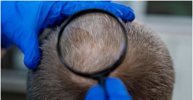 Μεταμόσχευση μαλλιών. Πώς πραγματοποιείται και ποια είναι τα οφέλη της;