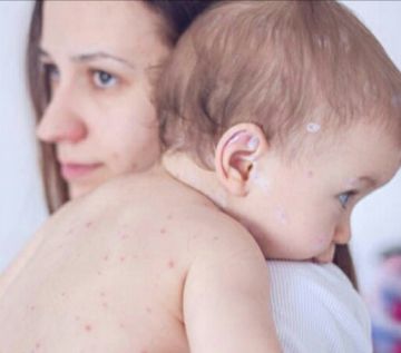 Συναγερμός από το ΚΕΕΛΠΝΟ: Είμαστε σε φάση επιδημικής έξαρσης ιλαράς