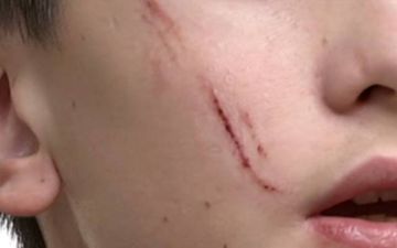  Νέα επίθεση στην Καλλιθέα: Μαθητής «χαράκωσε» με κλειδί στο πρόσωπο 14χρονο συμμαθητή του