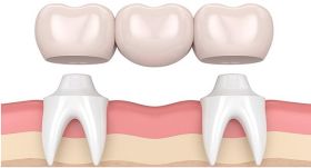 Γέφυρες δοντιών: διαδικασία, κόστος και τύποι οδοντικών γεφυρών