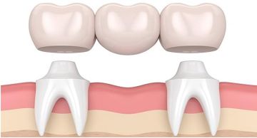 Γέφυρες δοντιών: διαδικασία, κόστος και τύποι οδοντικών γεφυρών