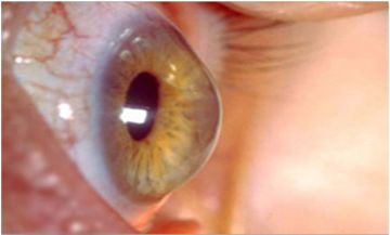 Κερατόκωνος: τι είναι, συμπτώματα, αίτια και σύγχρονες θεραπείες