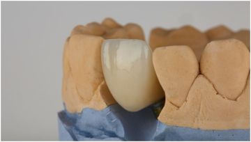 Θήκες δοντιών και στεφάνες: τι είναι, υλικά, κόστος και πότε χρειάζονται