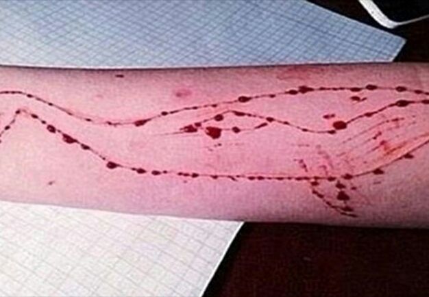 «Μπλε φάλαινα»: 14χρονη στη Θεσσαλονίκη χάραξε αριθμούς στα χέρια της